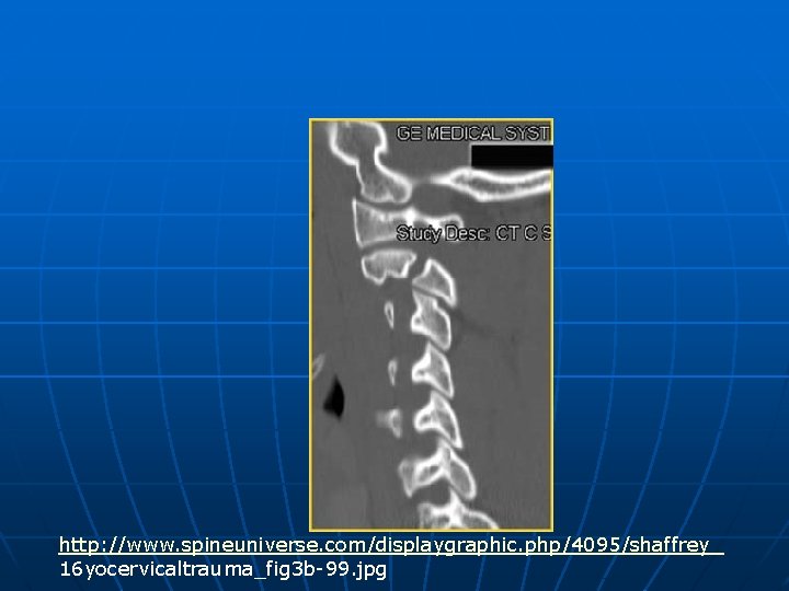 http: //www. spineuniverse. com/displaygraphic. php/4095/shaffrey_ 16 yocervicaltrauma_fig 3 b-99. jpg 