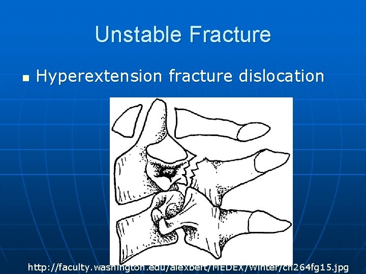 Unstable Fracture n Hyperextension fracture dislocation http: //faculty. washington. edu/alexbert/MEDEX/Winter/ch 264 fg 15. jpg