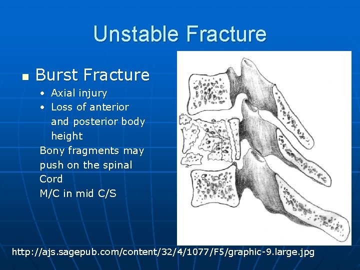 Unstable Fracture n Burst Fracture • Axial injury • Loss of anterior and posterior