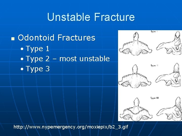 Unstable Fracture n Odontoid Fractures • Type 1 2 – most unstable 3 http: