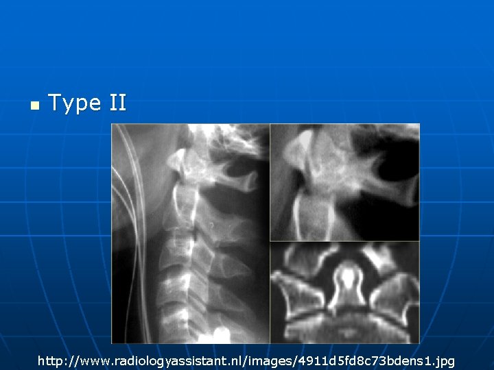 n Type II http: //www. radiologyassistant. nl/images/4911 d 5 fd 8 c 73 bdens