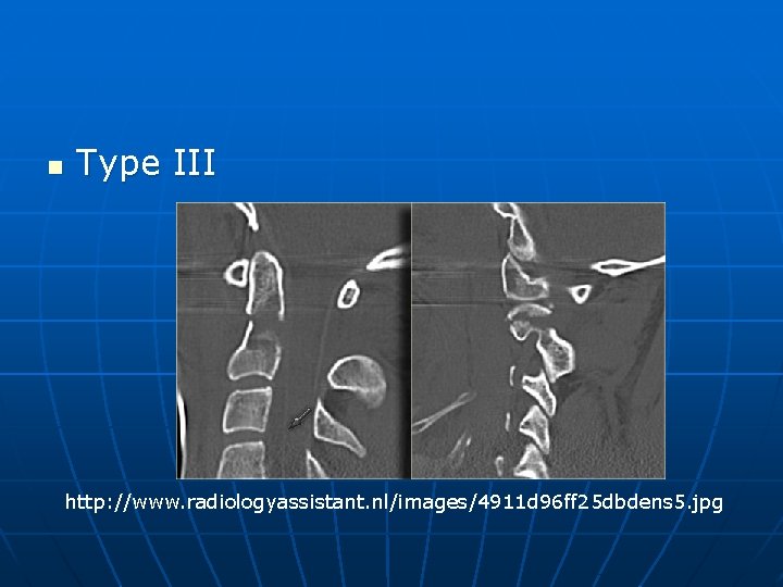 n Type III http: //www. radiologyassistant. nl/images/4911 d 96 ff 25 dbdens 5. jpg