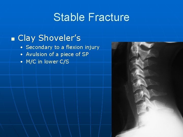 Stable Fracture n Clay Shoveler’s • Secondary to a flexion injury • Avulsion of