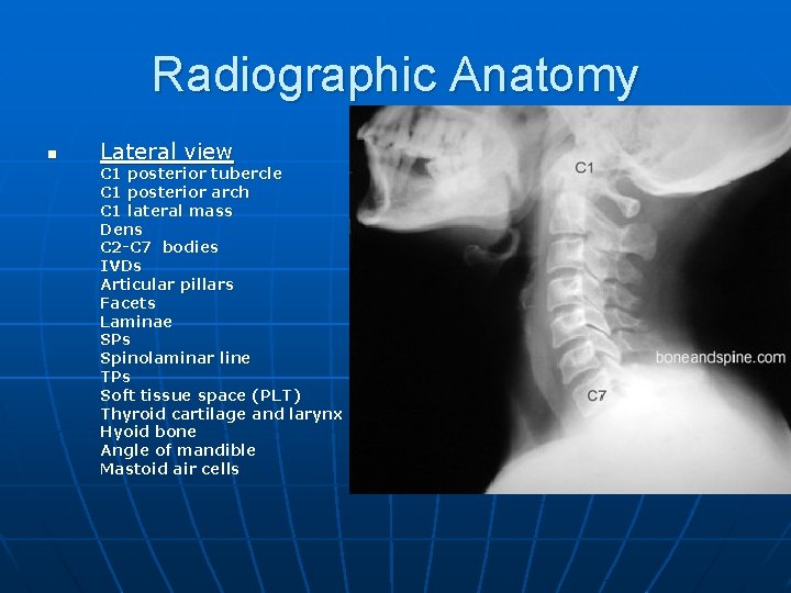 Radiographic Anatomy n Lateral view C 1 posterior tubercle C 1 posterior arch C