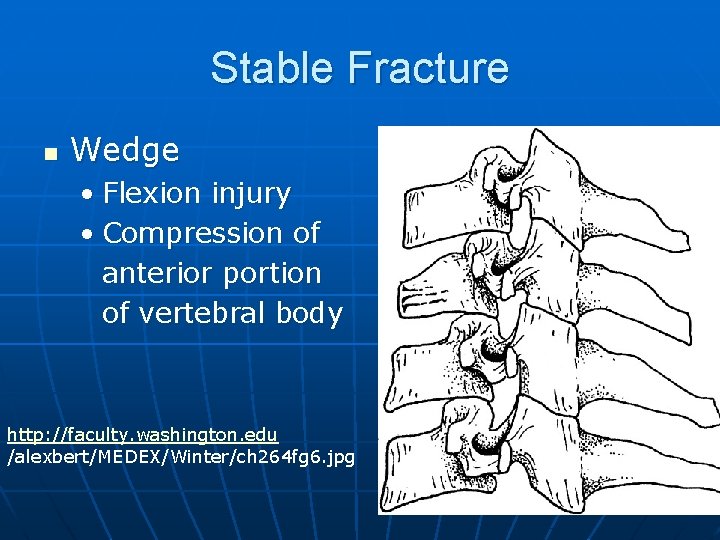 Stable Fracture n Wedge • Flexion injury • Compression of anterior portion of vertebral