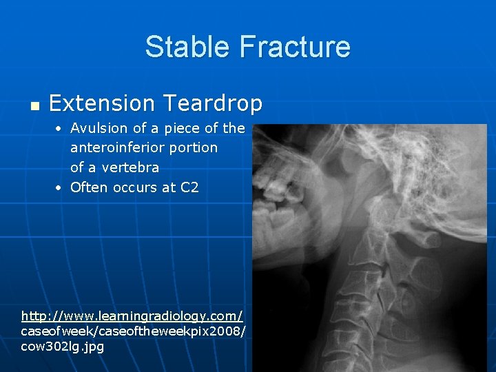Stable Fracture n Extension Teardrop • Avulsion of a piece of the anteroinferior portion