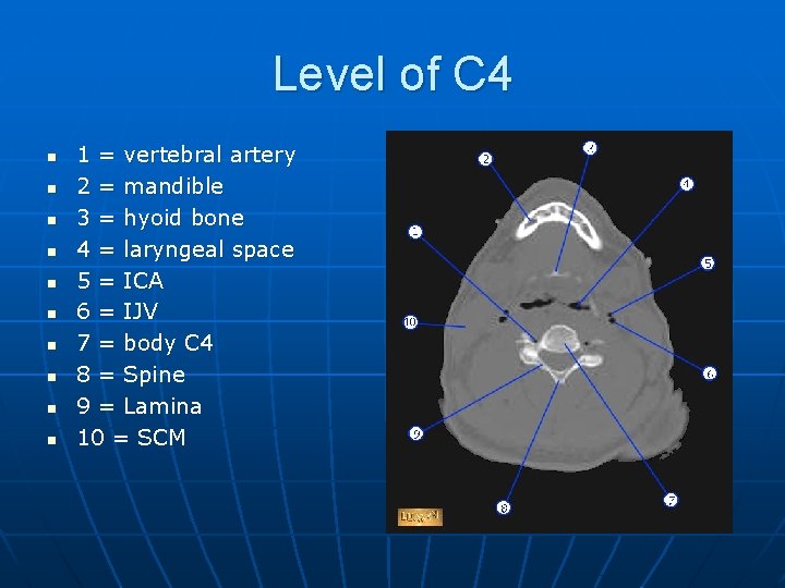 Level of C 4 n n n n n 1 = vertebral artery 2