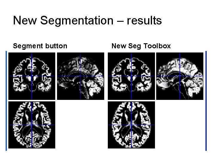 New Segmentation – results Segment button New Seg Toolbox 