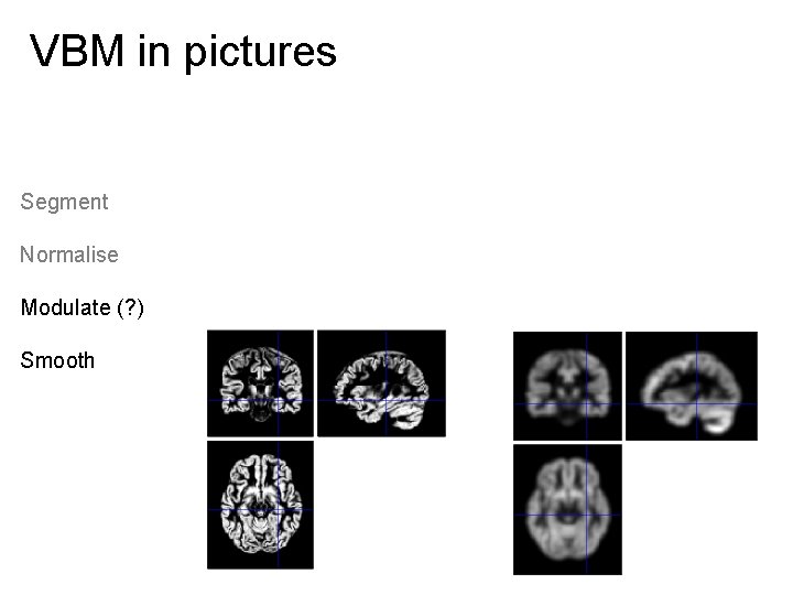 VBM in pictures Segment Normalise Modulate (? ) Smooth 