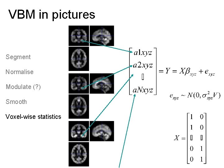 VBM in pictures Segment Normalise Modulate (? ) Smooth Voxel-wise statistics 