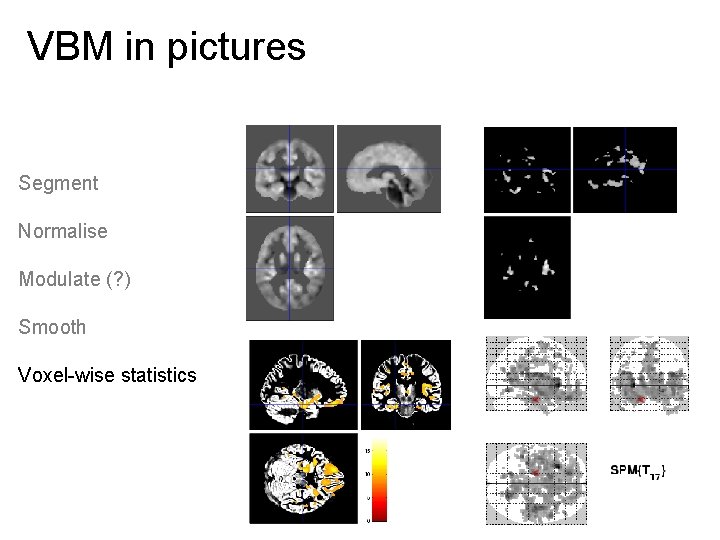 VBM in pictures Segment Normalise Modulate (? ) Smooth Voxel-wise statistics 