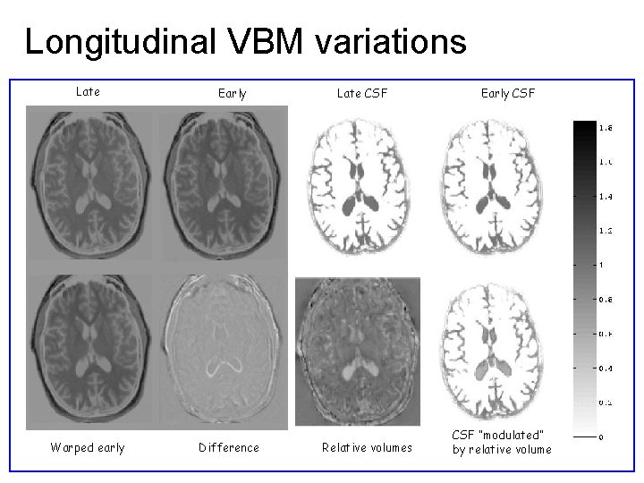 Longitudinal VBM variations Late Early Late CSF - Early CSF Late CSF - modulated