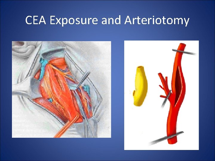 CEA Exposure and Arteriotomy 