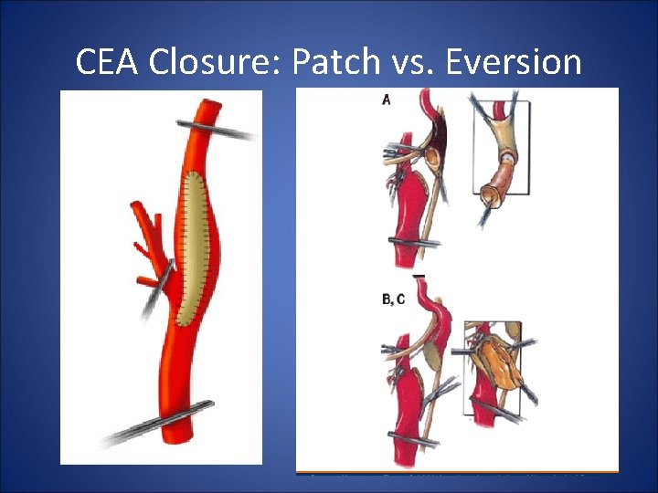CEA Closure: Patch vs. Eversion 