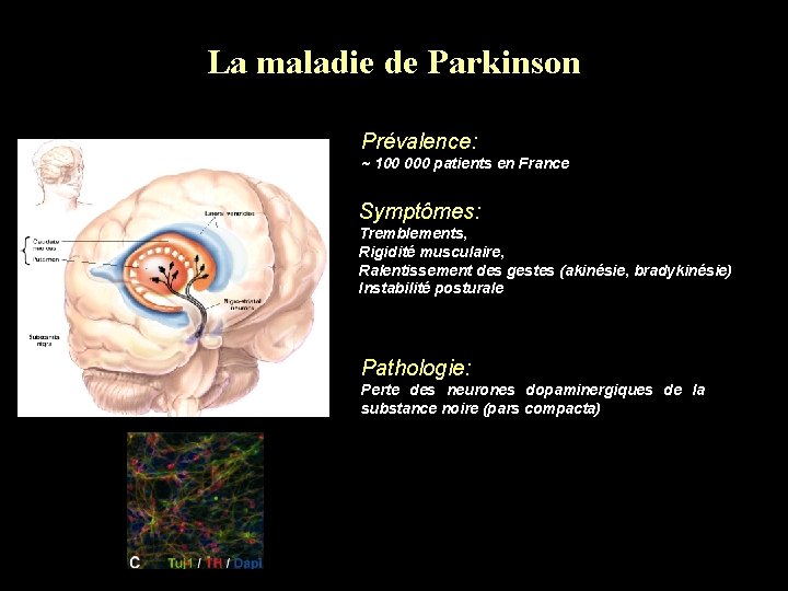 La maladie de Parkinson Prévalence: ~ 100 000 patients en France Symptômes: Tremblements, Rigidité