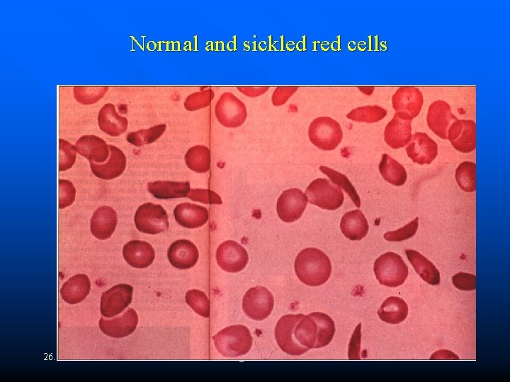 Normal and sickled red cells 26. 9. 2016 gens 20 b 4 