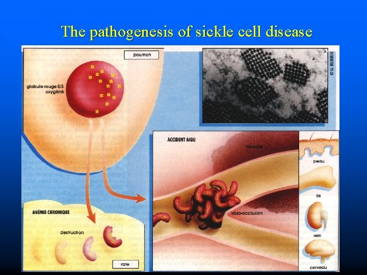 The pathogenesis of sickle cell disease 26. 9. 2016 gens 20 b 5 