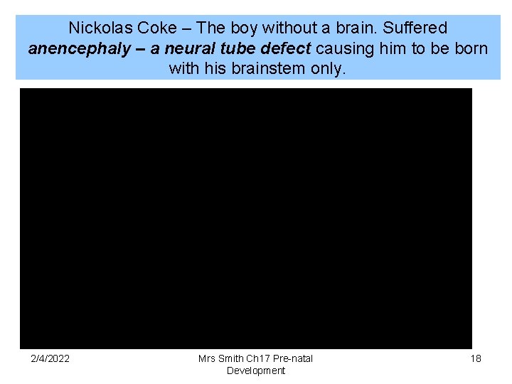 Nickolas Coke – The boy without a brain. Suffered anencephaly – a neural tube