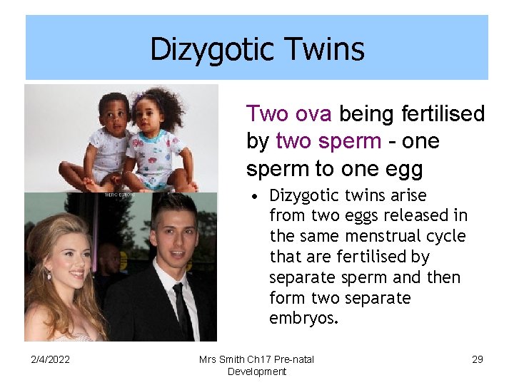 Dizygotic Twins Two ova being fertilised by two sperm - one sperm to one