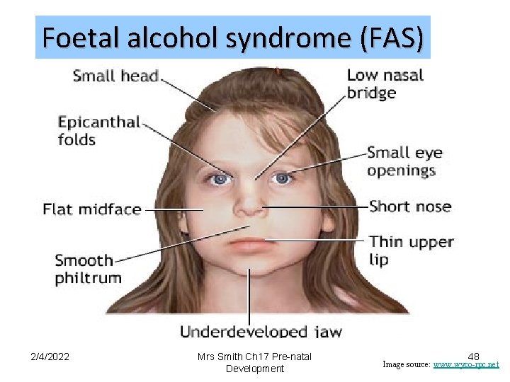 Foetal alcohol syndrome (FAS) 2/4/2022 Mrs Smith Ch 17 Pre-natal Development 48 Image source:
