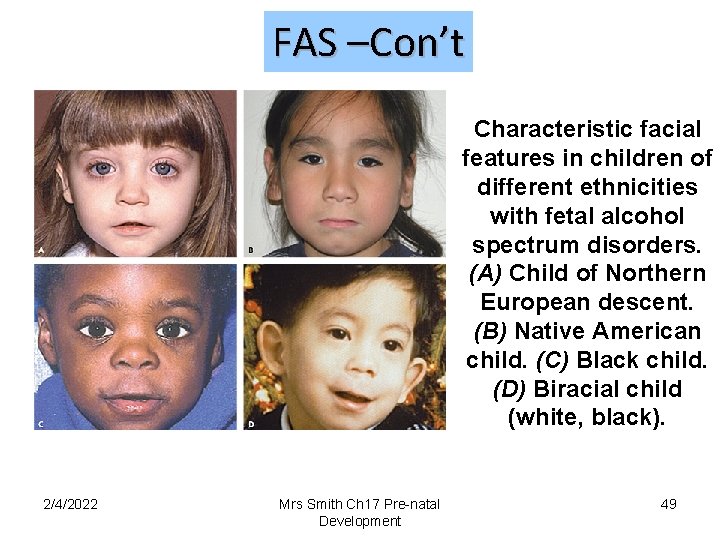 FAS –Con’t Characteristic facial features in children of different ethnicities with fetal alcohol spectrum