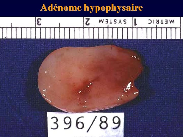 Adénome hypophysaire 