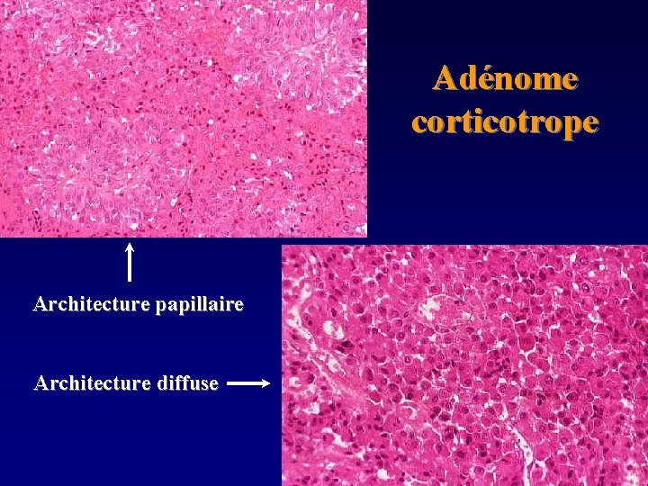 Adénome corticotrope Architecture papillaire Architecture diffuse 