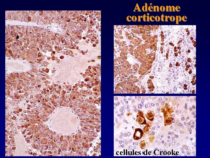 Adénome corticotrope cellules de Crooke 