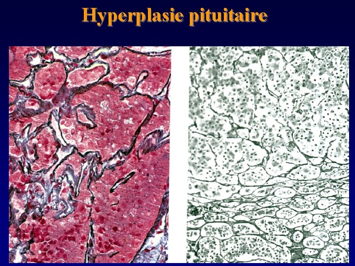 Hyperplasie pituitaire 