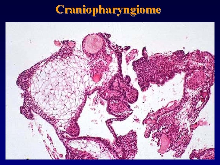 Craniopharyngiome 