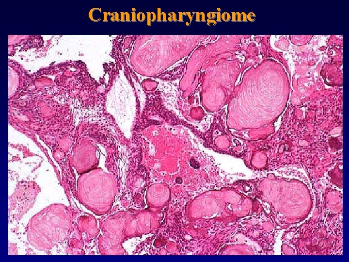 Craniopharyngiome 