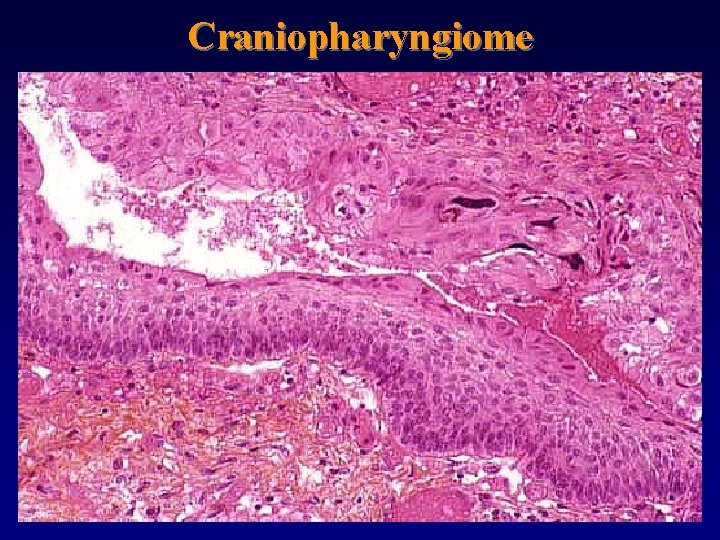 Craniopharyngiome 