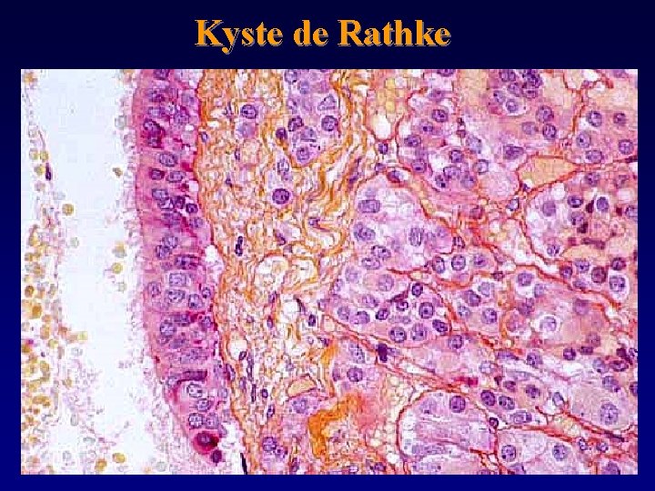 Kyste de Rathke 