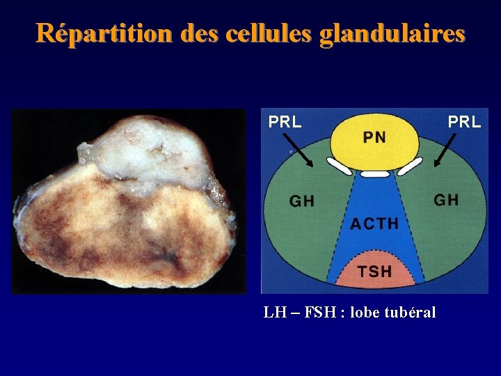Répartition des cellules glandulaires PRL LH – FSH : lobe tubéral PRL 