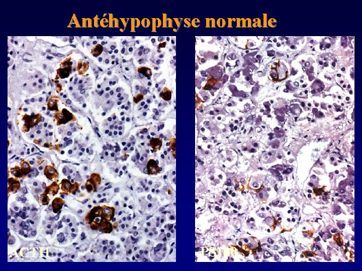 Antéhypophyse normale ACTH PS 100 