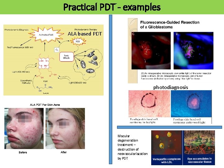Practical PDT - examples ALA based PDT photodiagnosis Macular degeneration treatment – destruction of