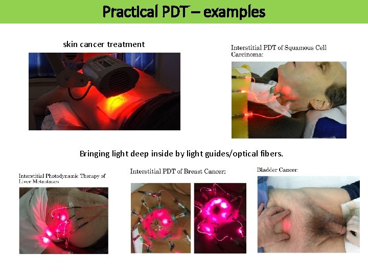 Practical PDT – examples skin cancer treatment Bringing light deep inside by light guides/optical