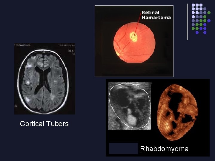 Cortical Tubers Rhabdomyoma 