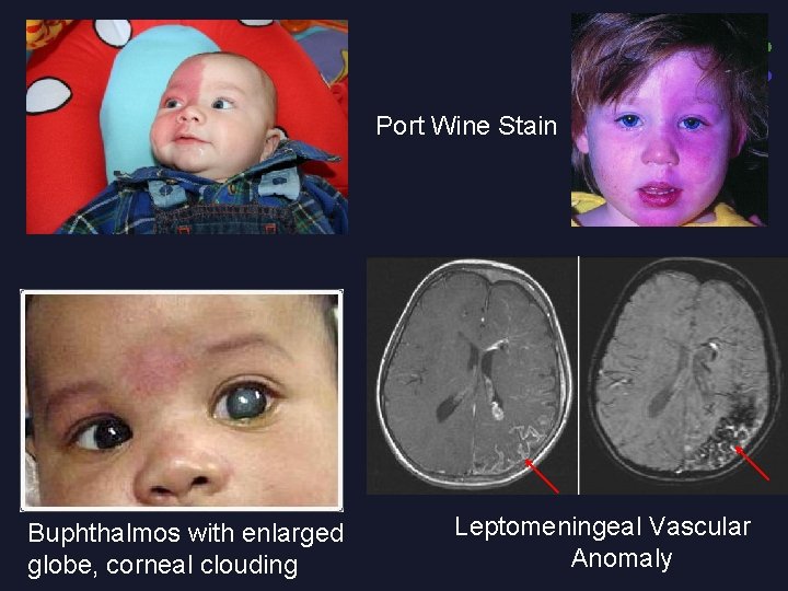 Port Wine Stain Buphthalmos with enlarged globe, corneal clouding Leptomeningeal Vascular Anomaly 