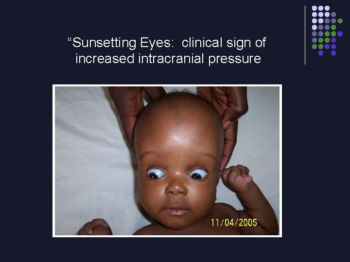 “Sunsetting Eyes: clinical sign of increased intracranial pressure 