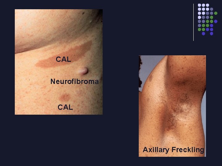 CAL Neurofibroma CAL Axillary Freckling 