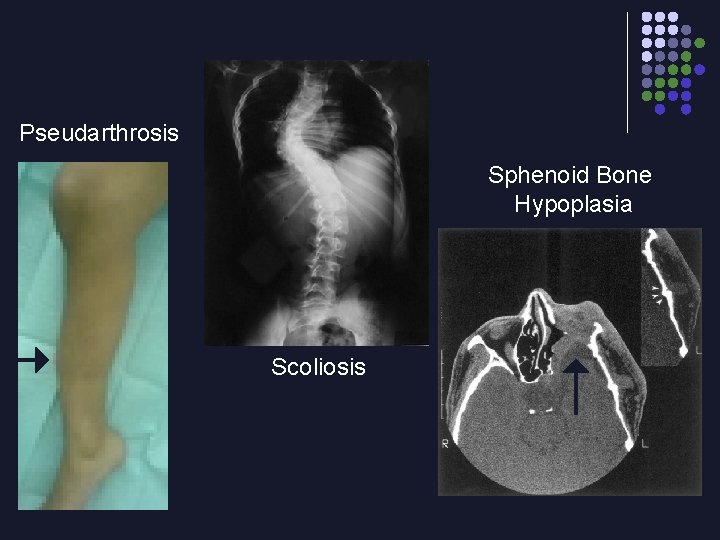 Pseudarthrosis Sphenoid Bone Hypoplasia Scoliosis 