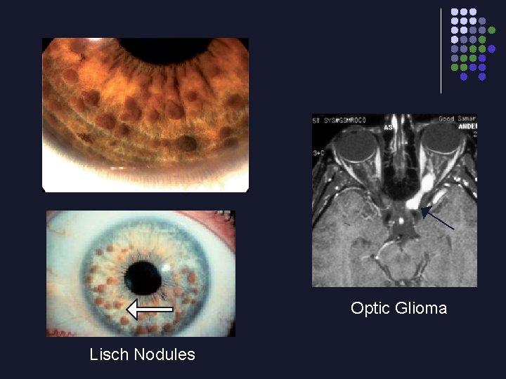Optic Glioma Lisch Nodules 