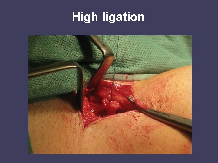 High ligation 