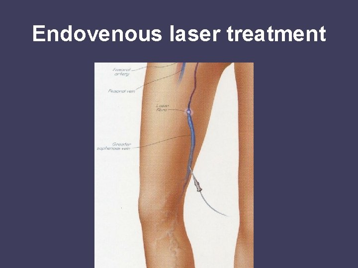 Endovenous laser treatment 