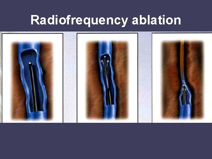 Radiofrequency ablation 