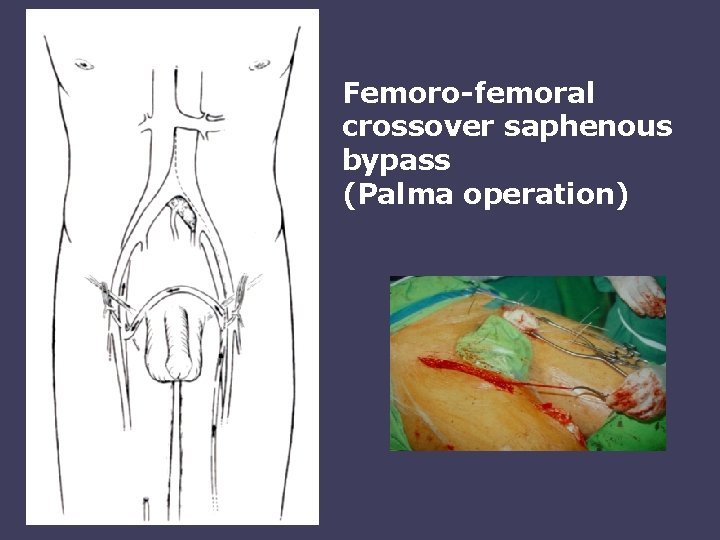 Femoro-femoral crossover saphenous bypass (Palma operation) 