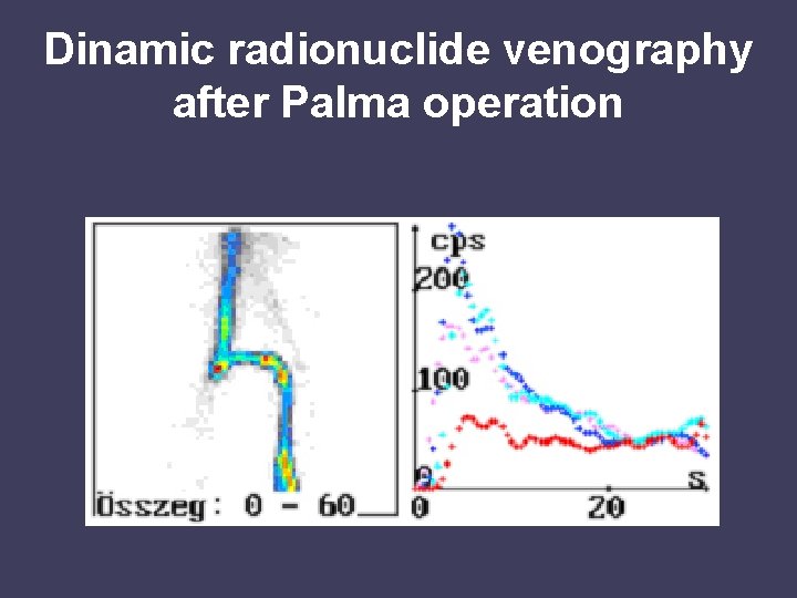 Dinamic radionuclide venography after Palma operation 
