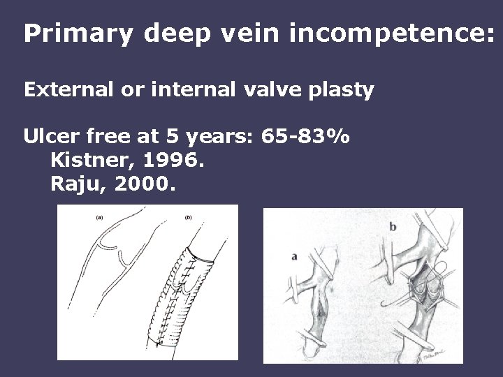 Primary deep vein incompetence: External or internal valve plasty Ulcer free at 5 years: