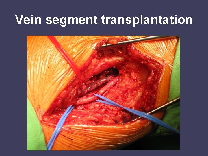 Vein segment transplantation 